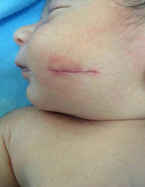 عکس/ تیغ پزشک بر صورت نوزاد در حین سزارین